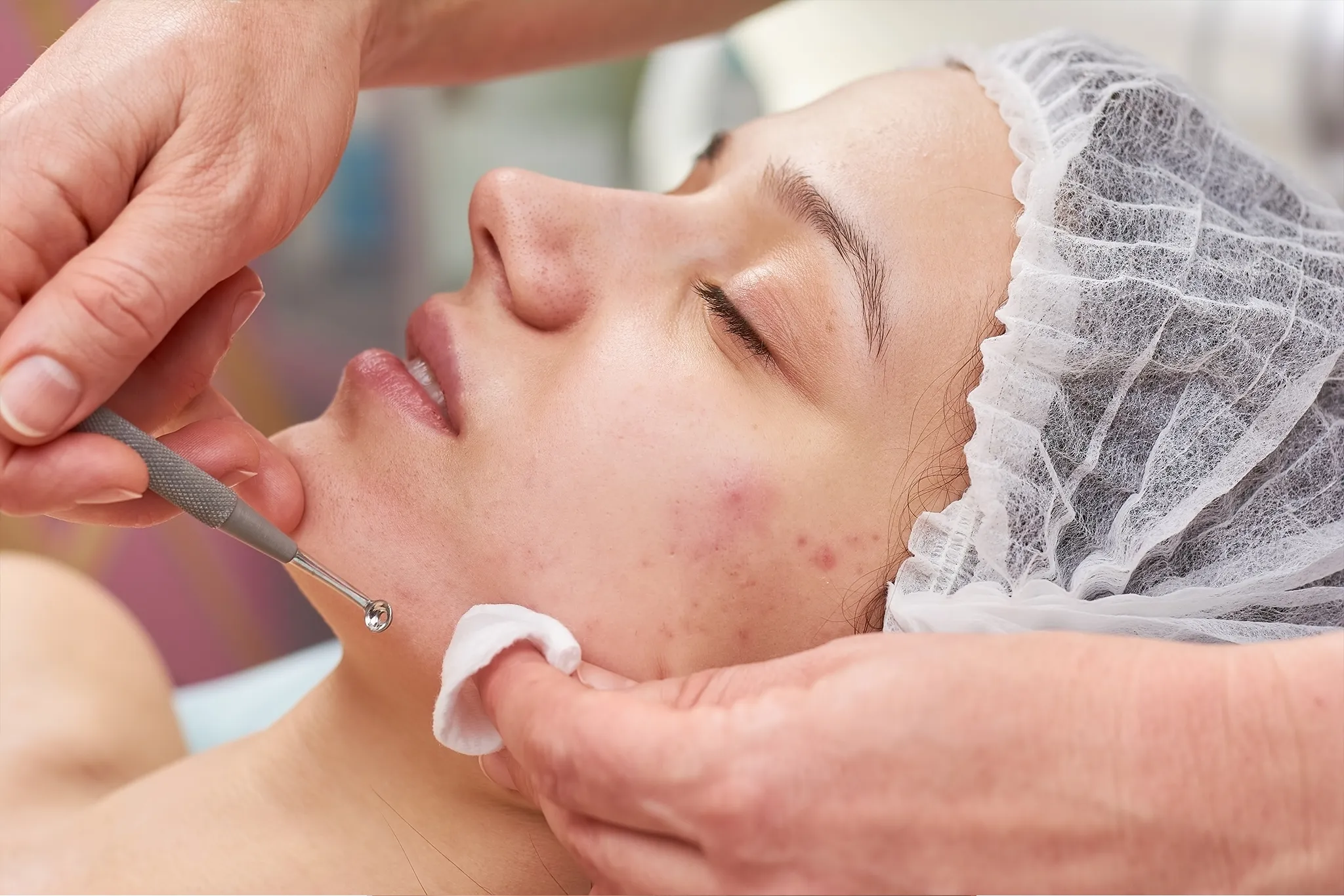 Acne Elimination Facial Darien, CT | Professional Acne Treatment Fairfield County