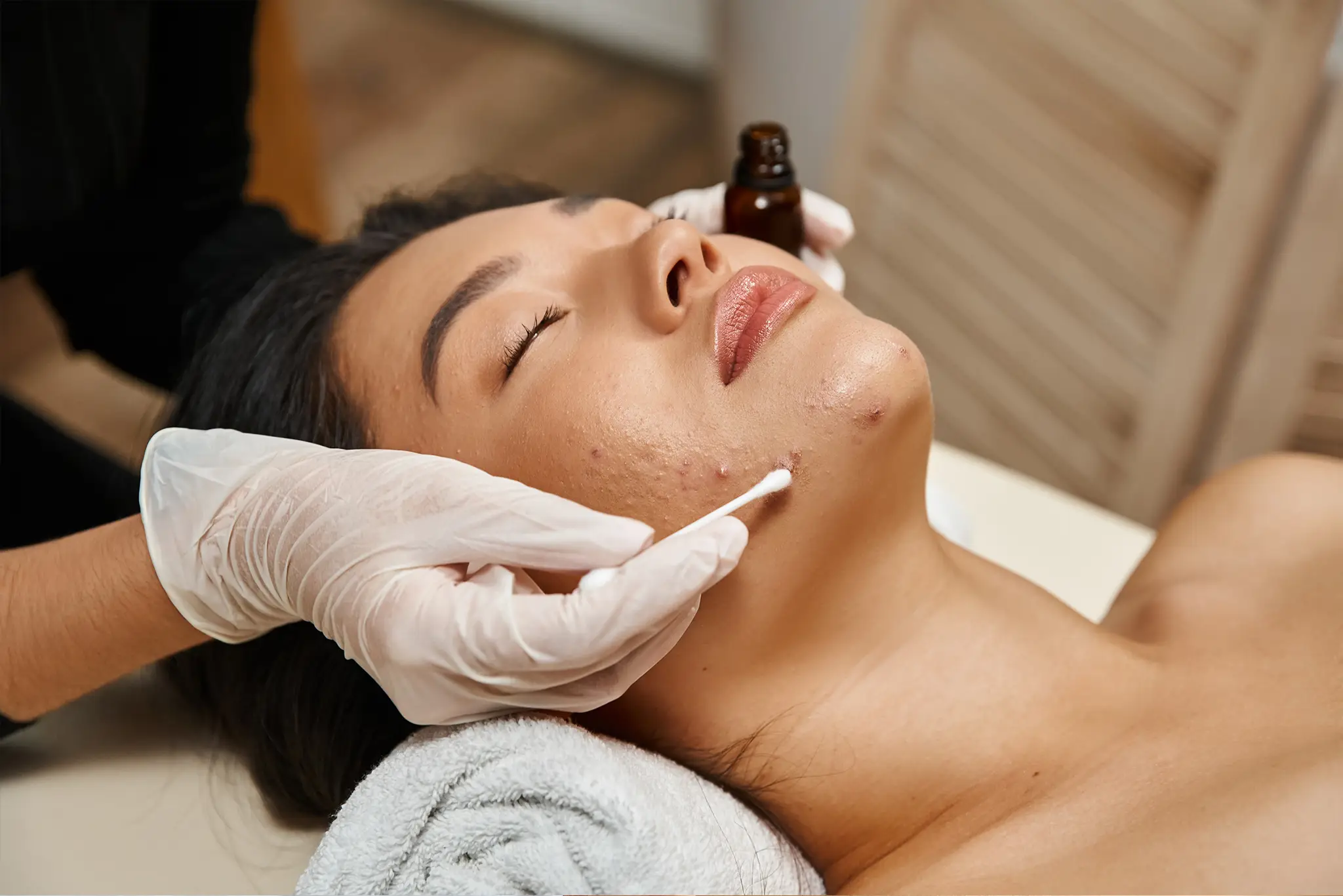 Acne cortisone injection Fairfield County CT