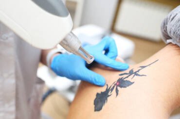 tattoo removal Darien